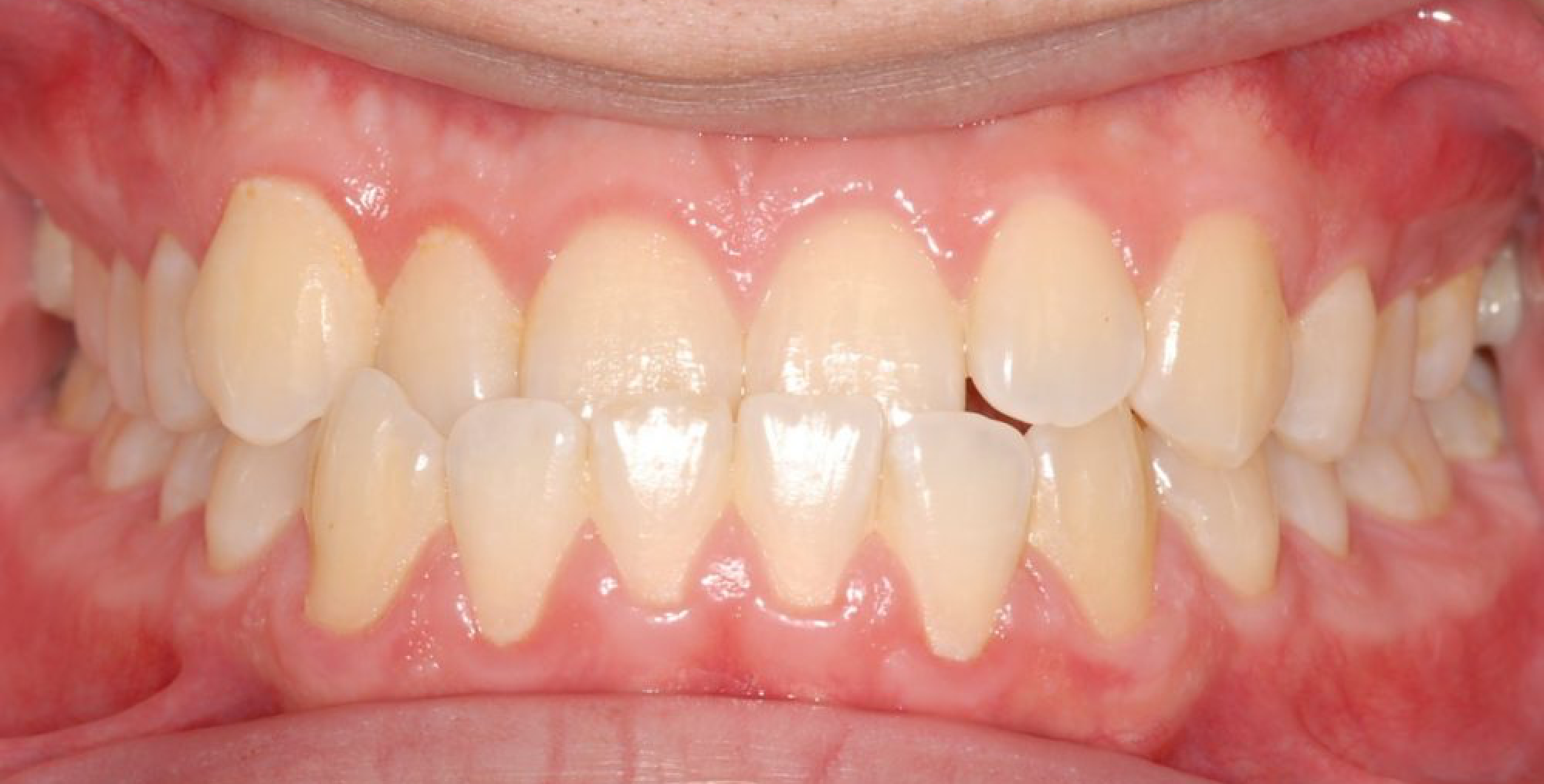 Résultat du traitement Invisalign avant et après
